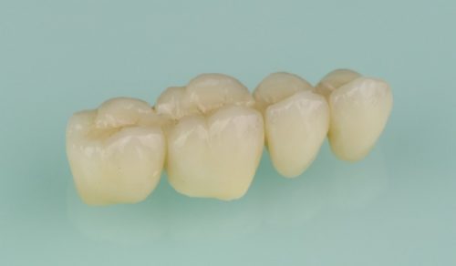 Brücke - DentAll 4 One